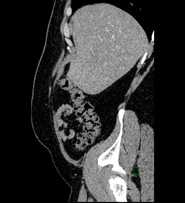 Chromophobe renal cell carcinoma (Radiopaedia 84286-99573 I 156).jpg