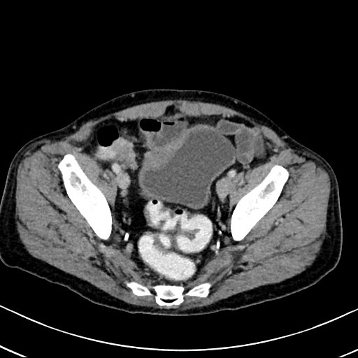 Chronic appendicitis complicated by appendicular abscess, pylephlebitis and liver abscess (Radiopaedia 54483-60700 B 124).jpg