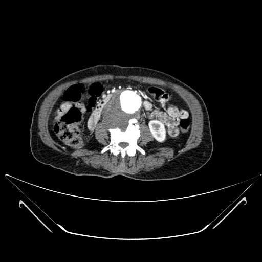 File:Chronic contained rupture of abdominal aortic aneurysm with extensive erosion of the vertebral bodies (Radiopaedia 55450-61901 A 33).jpg