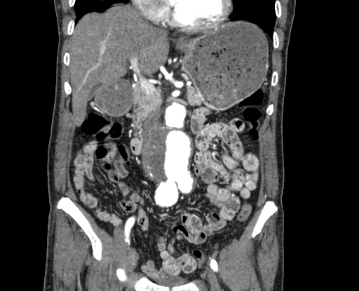 Chronic contained rupture of abdominal aortic aneurysm with extensive erosion of the vertebral bodies (Radiopaedia 55450-61901 D 24).jpg