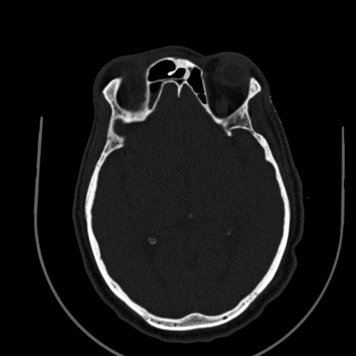 Chronic invasive fungal sinusitis (Radiopaedia 91563-109286 Axial sinus 116).jpg