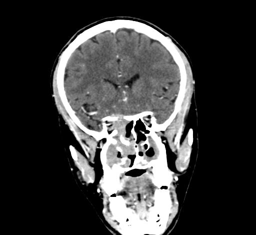 Chronic invasive fungal sinusitis with intraorbital and intracranial extension (Radiopaedia 56387-63046 C 140).jpg