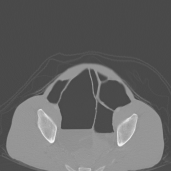 File:Chronic large bowel pseudo-obstruction (Radiopaedia 43181-46492 Axial bone window 145).jpg