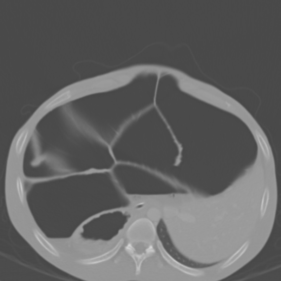 Chronic large bowel pseudo-obstruction (Radiopaedia 43181-46492 Axial bone window 46).jpg