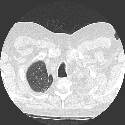 Chronic lung allograft dysfunction - restrictive form (Radiopaedia 60595-68316 Axial lung window 8).jpg