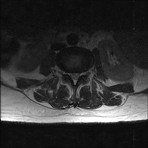 File:Chronic myeloid leukemia (MRI) (Radiopaedia 56128-62777 Axial T2 13).jpg