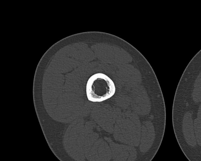 Chronic ostemyelitis of the femur with long sinus tract (Radiopaedia 74947-85982 Axial bone window 103).jpg