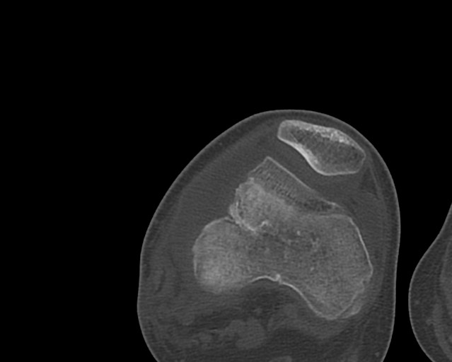 Chronic ostemyelitis of the femur with long sinus tract (Radiopaedia 74947-85982 Axial bone window 212).jpg