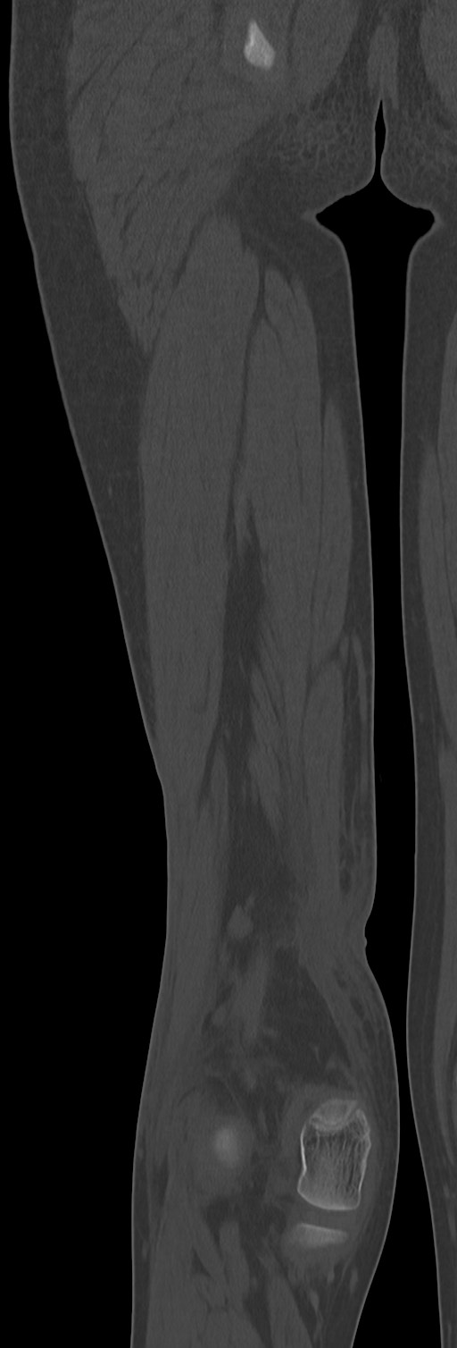 Chronic ostemyelitis of the femur with long sinus tract (Radiopaedia 74947-85982 Coronal bone window 60).jpg