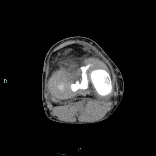 Chronic osteomyelitis (with Brodie abscess) (Radiopaedia 76405-88111 A 112).jpg