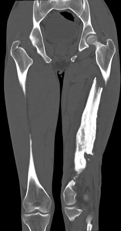 Chronic osteomyelitis (with sequestrum) (Radiopaedia 74813-85822 Coronal non-contrast 33).jpg