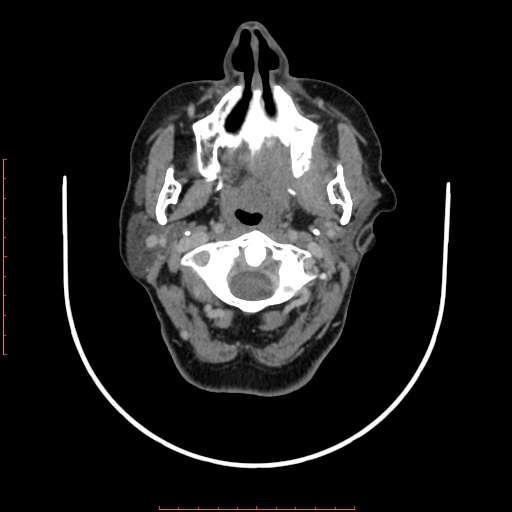 File:Chronic osteomyelitis - maxilla (Radiopaedia 23783-23927 B 69).jpg