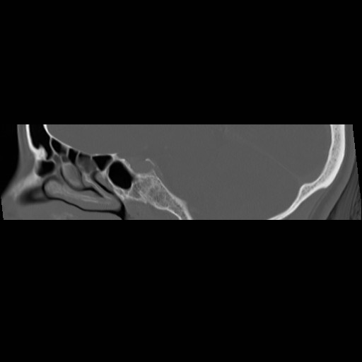 File:Chronic otomastoiditis (Radiopaedia 27138-27309 Sagittal bone window 27).jpg