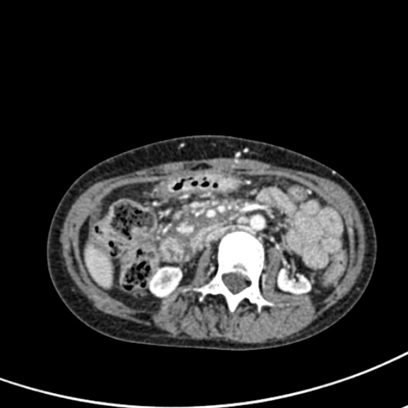 Chronic pancreatitis (Radiopaedia 55405-61846 A 47).jpg