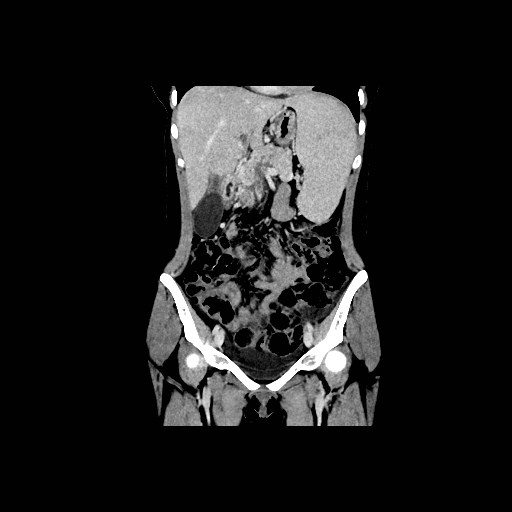 Chronic portal venous thrombosis with cavernous transformation (Radiopaedia 73618-84398 B 55).jpg
