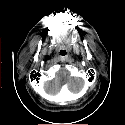 Chronic submandibular sialolithiasis (Radiopaedia 69817-79814 Axial non-contrast 42).jpg