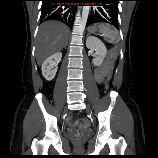 File:Circumaortic left renal vein (Radiopaedia 9069-9792 B 25).jpg