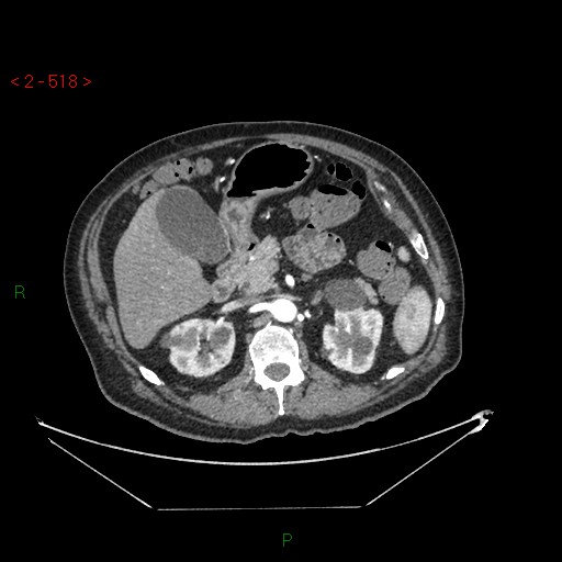 Circumaortic left renal vein and doubled left renal arteries (Radiopaedia 52268-58158 A 54).jpg