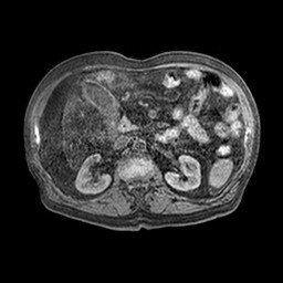 File:Cirrhosis and hepatocellular carcinoma in the setting of hemochromatosis (Radiopaedia 75394-86594 Axial T1 C+ fat sat 21).jpg