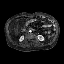 Cirrhosis and hepatocellular carcinoma in the setting of hemochromatosis (Radiopaedia 75394-86594 Axial T1 C+ fat sat 95).jpg
