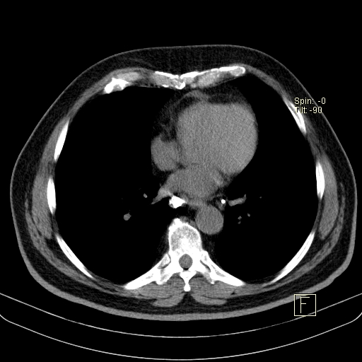 File:Classic complicated silicosis (Radiopaedia 49720-54961 Axial liver window 35).jpg