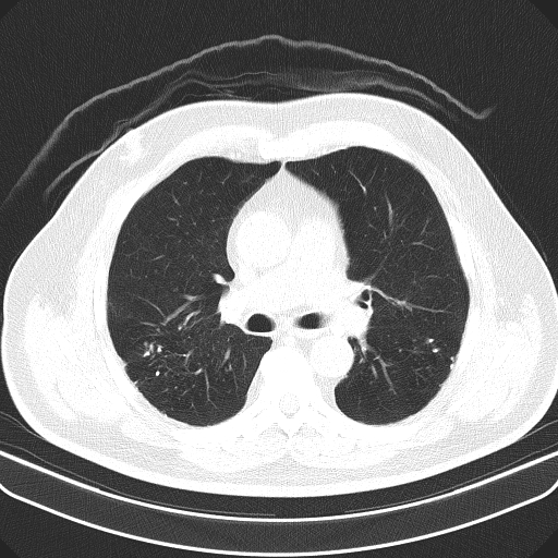 Classic complicated silicosis (Radiopaedia 49720-54961 Axial lung window 24).jpg