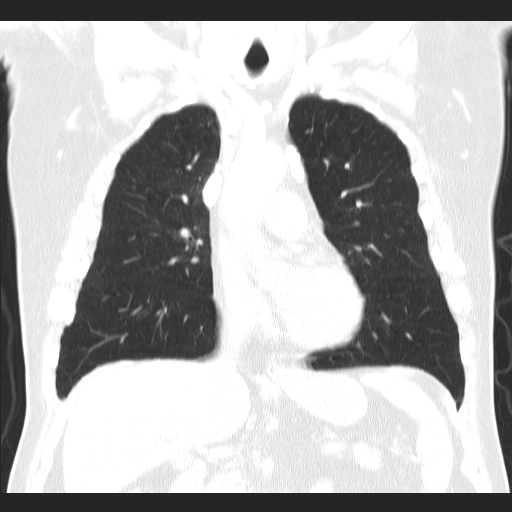 File:Classic complicated silicosis (Radiopaedia 49720-54961 Coronal lung window 25).jpg