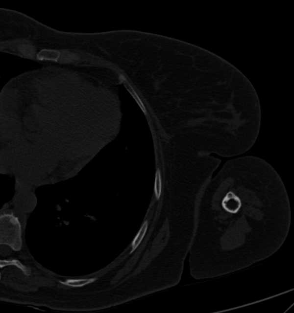 Clear cell chondrosarcoma - humerus (Radiopaedia 63104-71612 Axial bone window 105).jpg