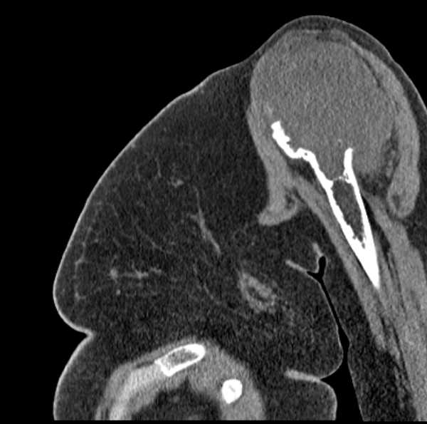 Clear cell chondrosarcoma - humerus (Radiopaedia 63104-71612 D 21).jpg