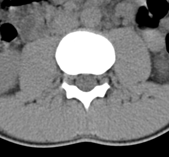 Clear cell meningoma - lumbar spine (Radiopaedia 60116-67691 Axial non-contrast 29).png