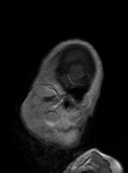 Clival meningioma (Radiopaedia 53278-59248 Sagittal T1 C+ 133).jpg