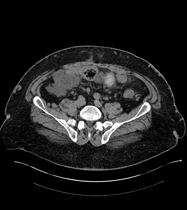 Closed-loop small bowel obstruction-internal hernia (Radiopaedia 78439-91096 Axial non-contrast 111).jpg
