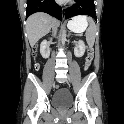 Closed-loop small bowel obstruction (Radiopaedia 73713-84509 C 72).jpg