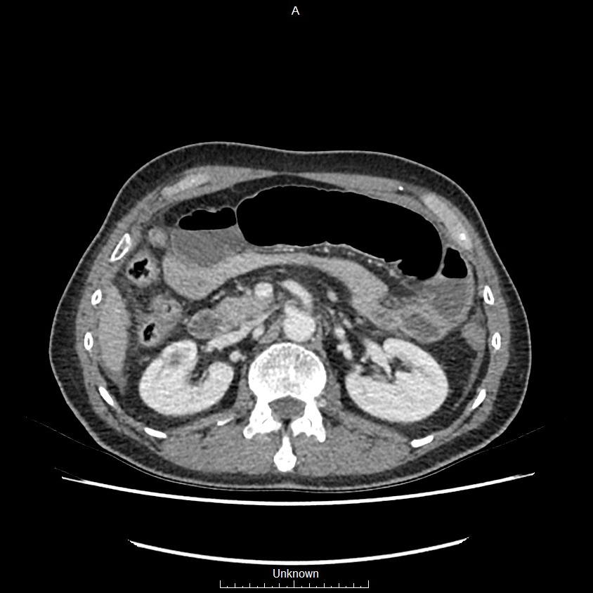 Closed loop bowel obstruction and ischemia (Radiopaedia 86959-103180 A 26).jpg