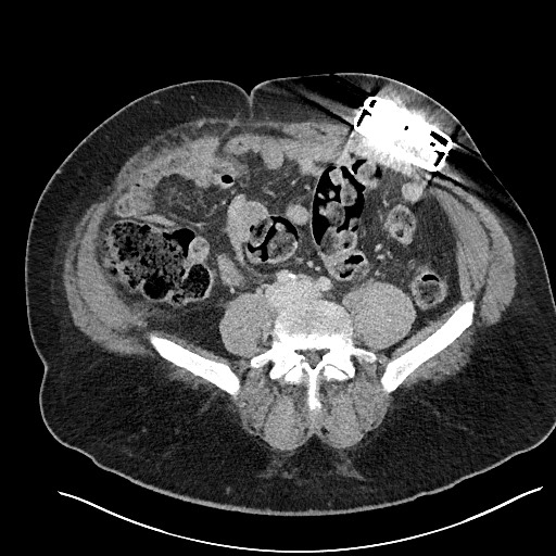 File:Closed loop obstruction - internal hernia into nephrectomy bed (Radiopaedia 59867-67320 A 92).jpg