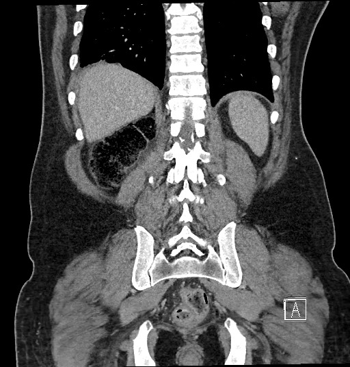 Closed loop obstruction - internal hernia into nephrectomy bed (Radiopaedia 59867-67320 B 112).jpg