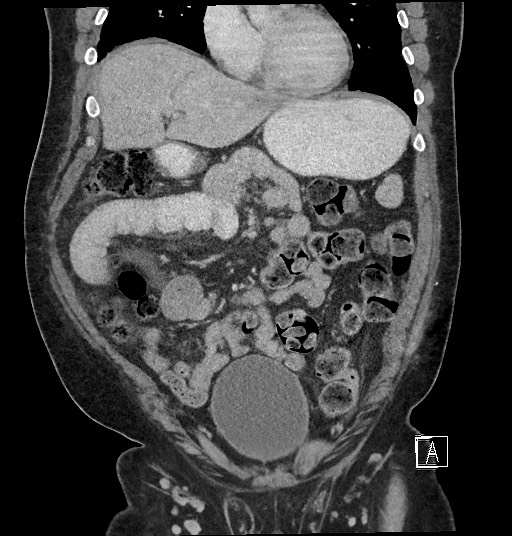 File:Closed loop obstruction - internal hernia into nephrectomy bed (Radiopaedia 59867-67320 B 45).jpg
