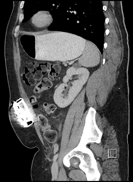 Closed loop obstruction - internal hernia into nephrectomy bed (Radiopaedia 59867-67320 C 22).jpg