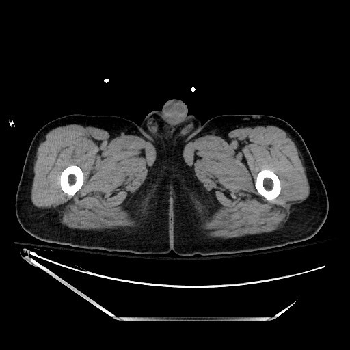 File:Closed loop obstruction due to adhesive band, resulting in small bowel ischemia and resection (Radiopaedia 83835-99023 Axial non-contrast 185).jpg