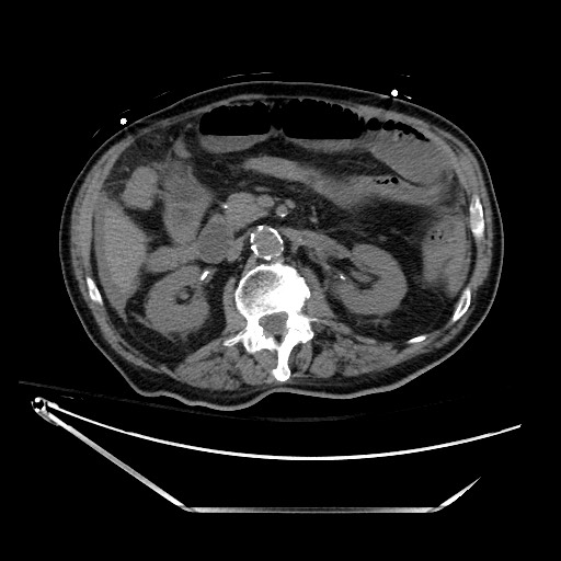 File:Closed loop obstruction due to adhesive band, resulting in small bowel ischemia and resection (Radiopaedia 83835-99023 Axial non-contrast 62).jpg
