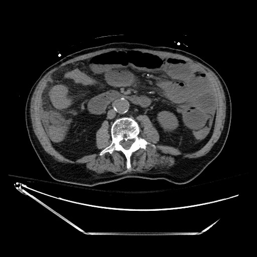 File:Closed loop obstruction due to adhesive band, resulting in small bowel ischemia and resection (Radiopaedia 83835-99023 Axial non-contrast 78).jpg