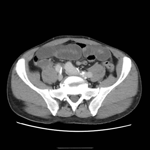 Closed loop small bowel obstruction (Radiopaedia 59227-66554 A 62).jpg