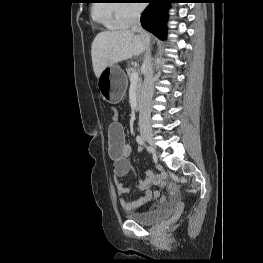 Closed loop small bowel obstruction (Radiopaedia 65403-74451 C 46).jpg