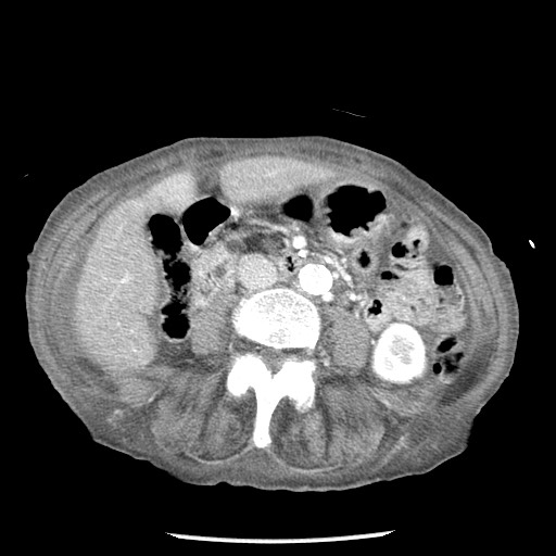 Closed loop small bowel obstruction - adhesions and infarct (Radiopaedia 85125-100678 B 49).jpg