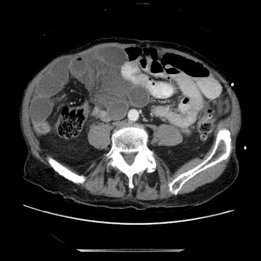 File:Closed loop small bowel obstruction - adhesive disease and hemorrhagic ischemia (Radiopaedia 86831-102990 A 119).jpg