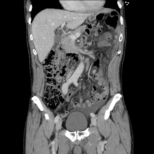 Closed loop small bowel obstruction - omental adhesion causing "internal hernia" (Radiopaedia 85129-100682 B 53).jpg