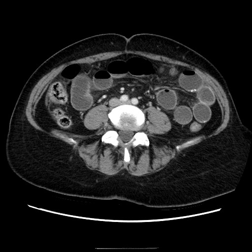 Closed loop small bowel obstruction due to adhesive bands - early and late images (Radiopaedia 83830-99015 A 101).jpg