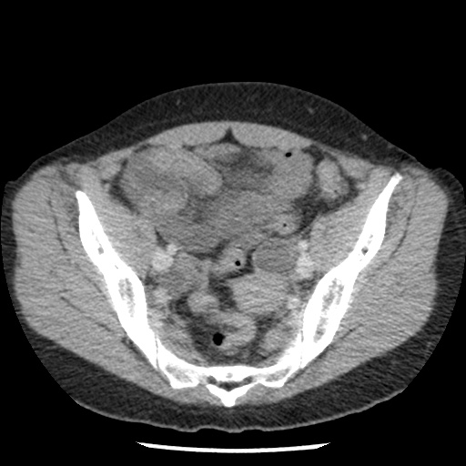 File:Closed loop small bowel obstruction due to trans-omental herniation (Radiopaedia 35593-37109 A 70).jpg