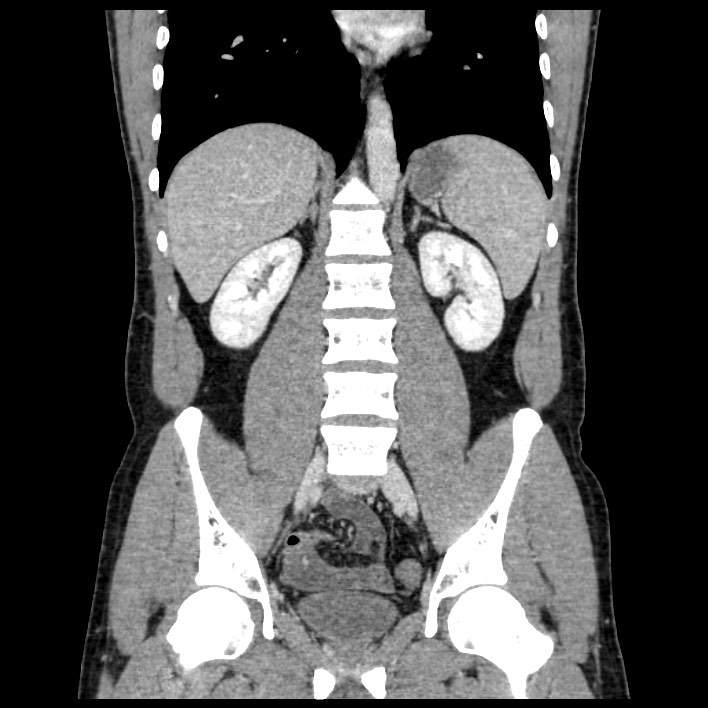 Co-existing acute appendicitis and epiploic appendagitis (Radiopaedia 61789-69911 C 41).jpg