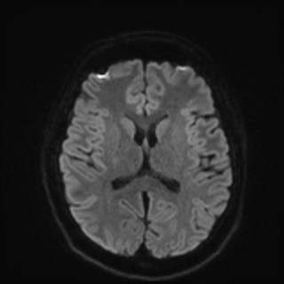 Cochlear incomplete partition type III associated with hypothalamic hamartoma (Radiopaedia 88756-105498 Axial DWI 63).jpg